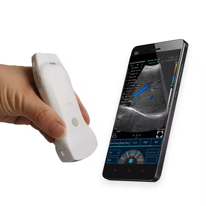 Sonde échographique et smartphone